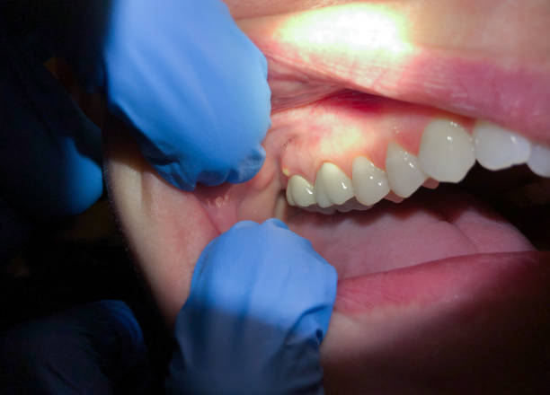 Best Emergency Wisdom Teeth Removal in Homer, GA